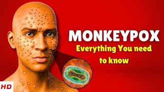 What is Monkeypox Causes, Signs and Symptoms, Treatment & Prevention