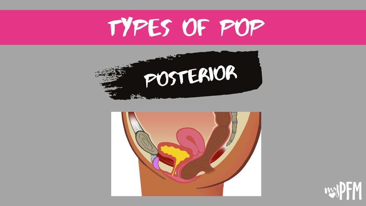 Posterior Vaginal Wall Prolapse (Rectocele)