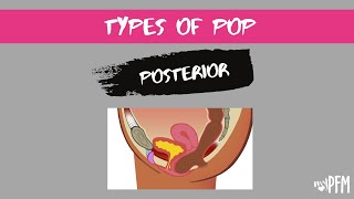 Posterior L Wall Prolapse Rectocele