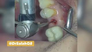 Flapless Dental Implant placement زراعة اسنان بدون فتح لثه جراحياً بشكل كامل