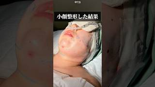 【脂肪吸引】落ちない脂肪を除去した結果#shorts