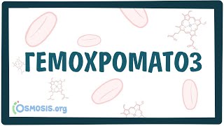 Гемохроматоз — причины, симптомы, патогенез, диагностика, лечение