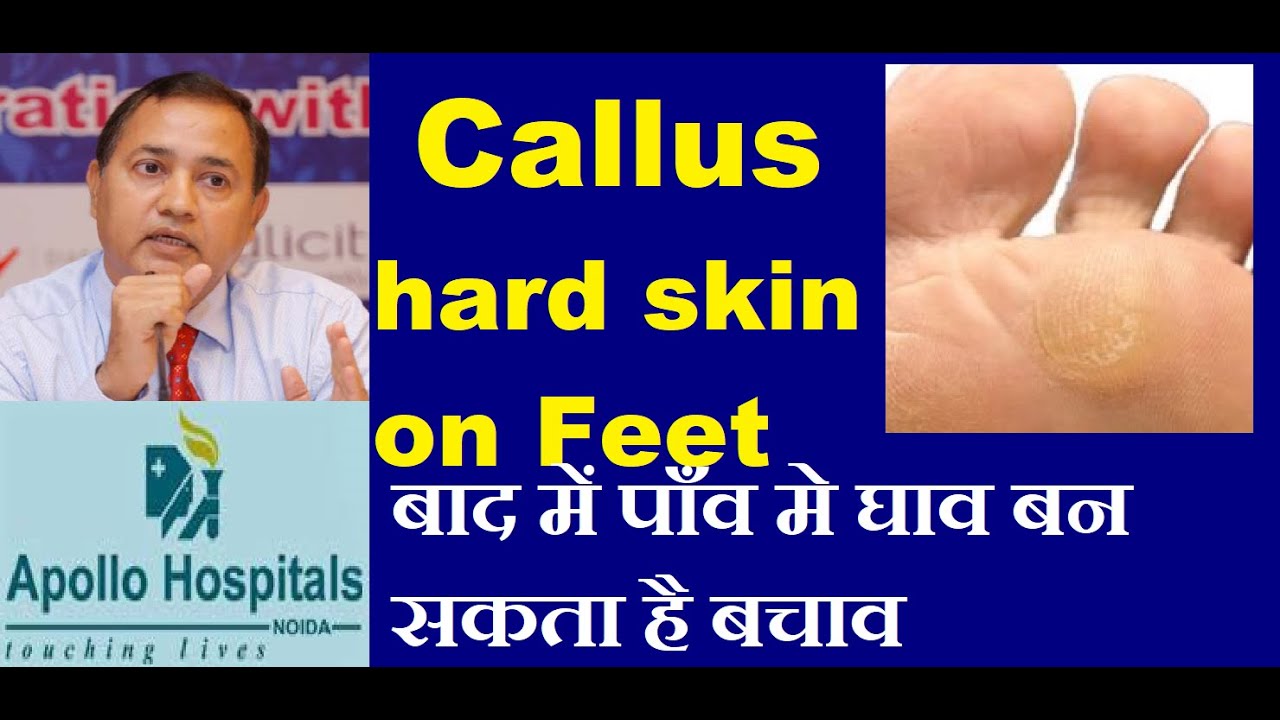 Callus Callosity Hard Skin on Feet in Diabetes lead to Diabetic Foot