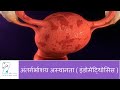 अंतर्गर्भाशय अस्थानता और उसके प्रभाव