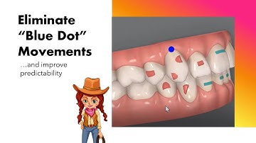 Invisalign ClinCheck - Eliminate "Blue Dot" TMA Movements