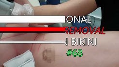 Professional Laser Hair Removal * Brazilian Bikini * Video #68 