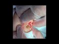 ⑤ 粉瘤くりぬき法 epidermal cyst atheroma cystic acne extractions 脂肪腫 lipoma 大阪心斎橋　大阪梅田院　名古屋栄院　福岡天神院　尼崎院 西宮院