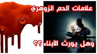 كيف للانسان ان يعرف ان دمه زوهري/وهل الزوهرية تورث من الآباء للأبناء