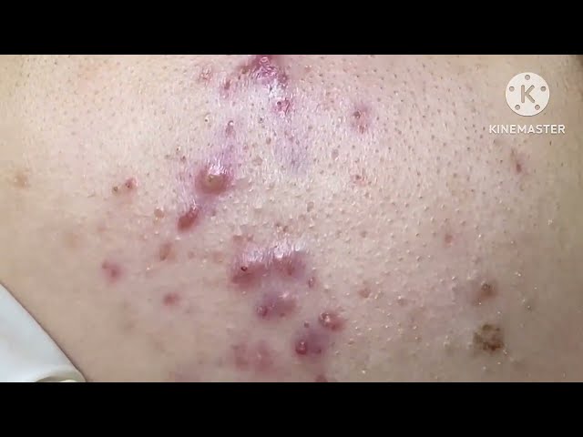 Inflammatory acne - Hoang My Spa #32