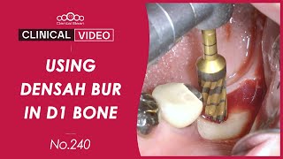 Implant placement using Densah bur in D1 bone quality - [Dr. Kim Yongjin]