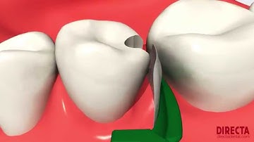 FenderMate® by Directa -  protects tooth and gingiva during class II preparations