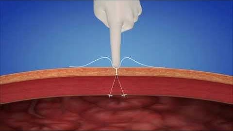 neoClose® port site closure device animation