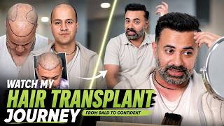 Hair Transplant in India (HX-YOON) | Best Results & Cost of Hair Transplant in  India