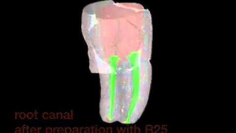 VDW Dental · Micro-CT-Scan of a lower molar (clinical video)