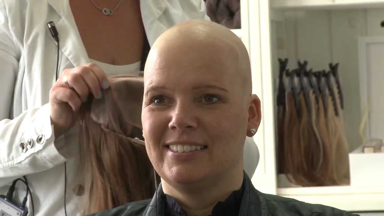 Jong en kaal, wat nu?