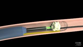 An NTrap basket prevents against the migration of ureteral stone fragments during laser lithotripsy