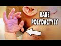 RARE POLYDACTYLY (newborn) | Dr. Paul