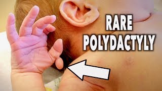 RARE POLYDACTYLY (newborn) | Dr. Paul