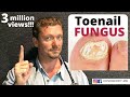 How to CURE Toenail Fungus (And keep it Gone FOREVER)