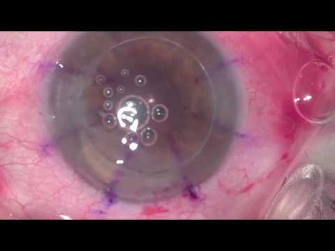 Operatie combinata  tripla: cataracta + implant de cristalin + transplant de cornee