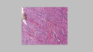 Histology- Granulation Tissue