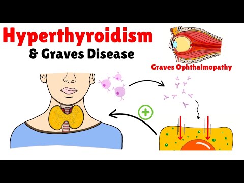 Hyperthyroidism & Graves Disease EXPLAINED: Causes, Symptoms, Treatment