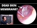 Unusual Dead Skin Membrane Occluding Ear Canal