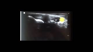 Ultrasound Guided Posterior Tibial Tendon Injection