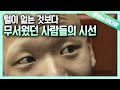 머리카락, 눈썹, 코털까지 온몸에 털이 빠진 학생┃A Student Who Lost All of Hair, Eyebrows, Nose Hair