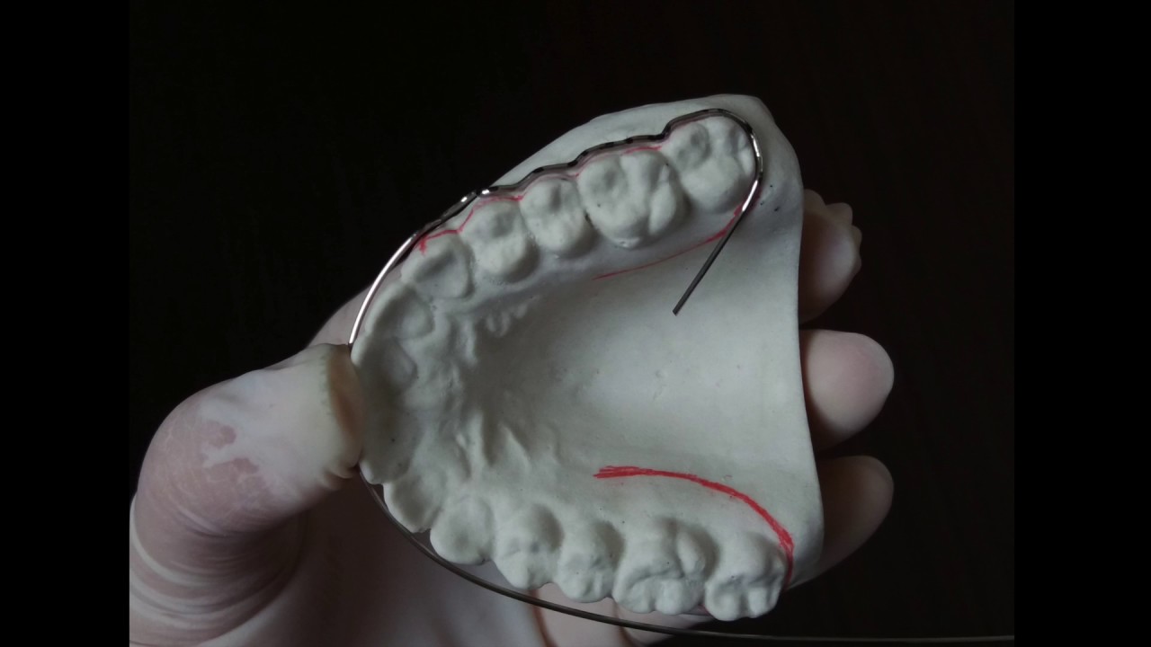 Contenção Ortodôntica tipo Arco contínuo