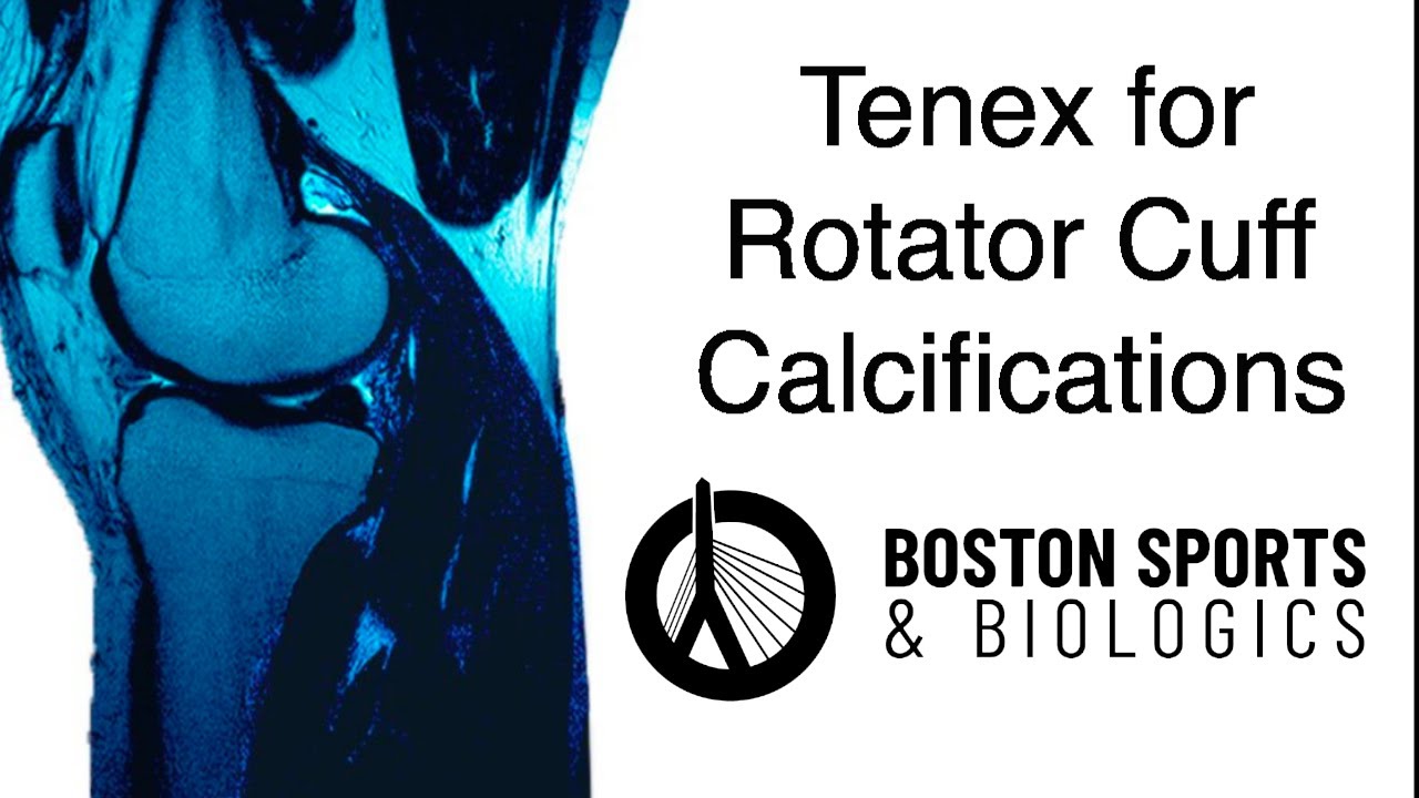 Tenex Calcification Tenex for Rotator Cuff Calcifications - YouTube