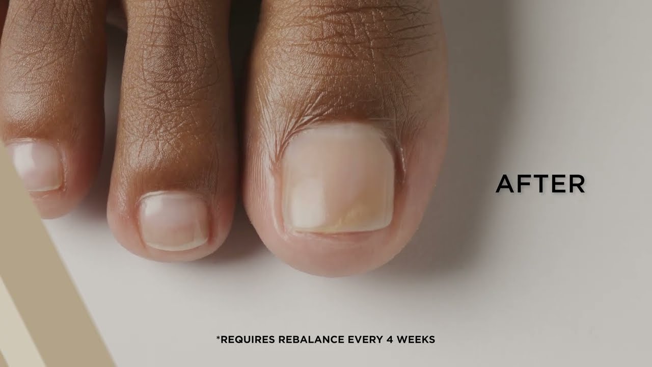 CND™ Transformation Education Tutorial | Broken Toenail with CND™ PLEXIGEL