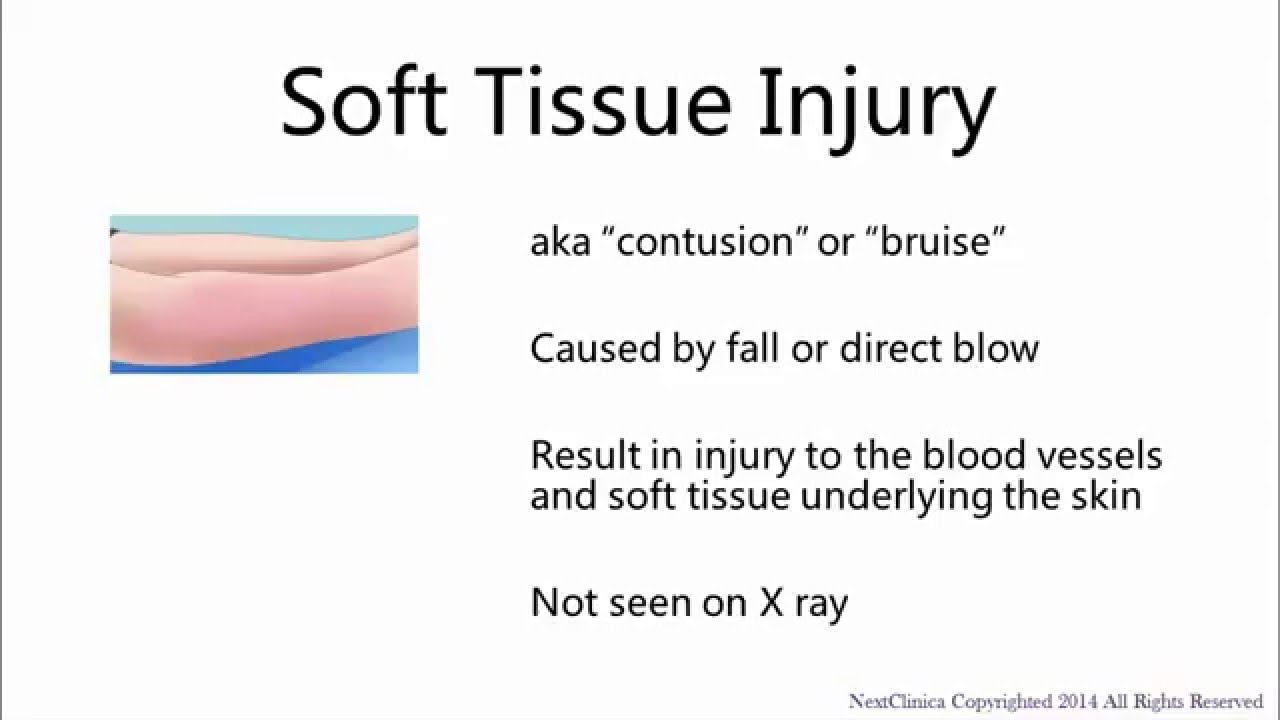 Soft Tissue Injury Youtube