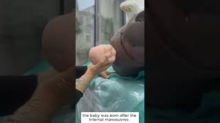 Shoulder Dystocia Management – Step by Step Guide for Midwives