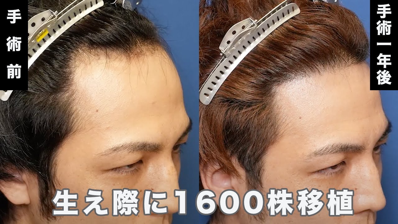 Dr.今川の植毛体験記 専門医が自分の髪で実践したドキュメント 最先端の自毛植… Dr.今川の植毛体験記 専門医が自分の髪で実践したドキュメント