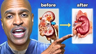 How To Avoid Dialysis Naturally 