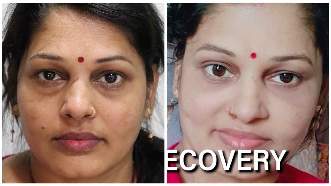 Get rid of Puffy Eyes forever in just 45 mins Eye Bags Removal