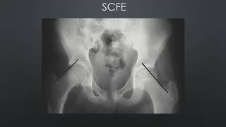 Commonly Missed Lower Extremity Fractures