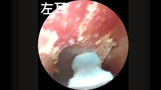 QiPOWERのスマート耳かき「QE-1」で自分の耳の中を見ながら耳かきしてみた