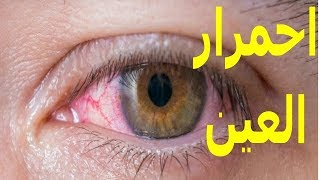 8 أسباب لاحمرار العين | تعرف عليها | الموسوعة العلمية