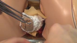 Vaginal Hysterectomy Simulation