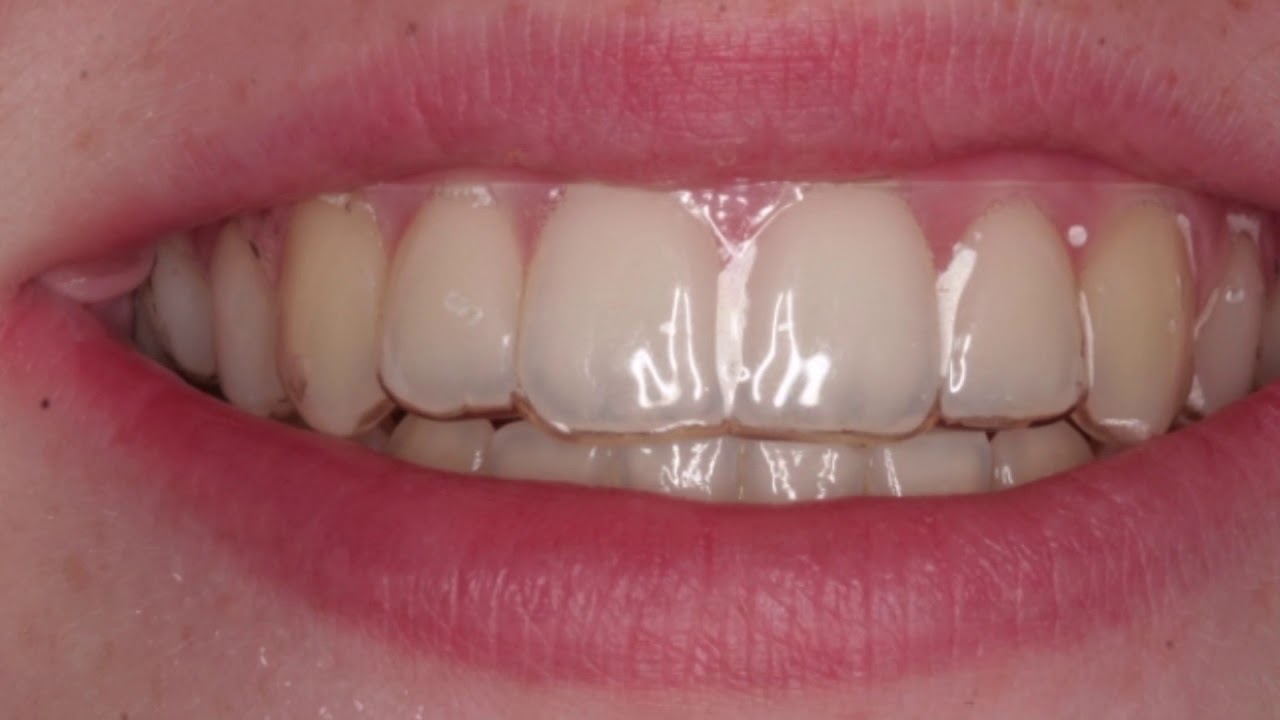 Essix Retainer - YouTube