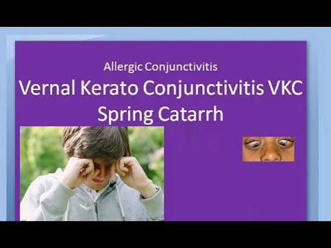 Ophthalmology 088 a Vernal KeratoConjunctivitis VKC Spring Catarrh Allergic Horner Tranta Eye