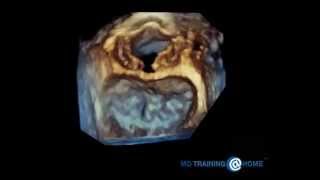 Echo CME: 3D TEE Mitral and Aortic Valve