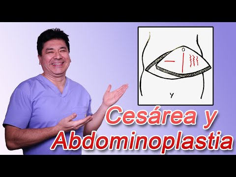 Vídeo: Abdominoplastia Después De Una Cesárea: ¿es Seguro?