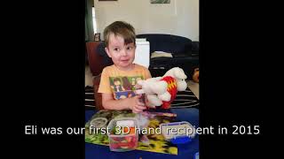 Eli receiving two new Kinetic Hands!