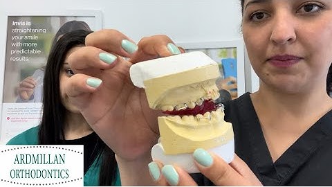 What is the Twin Block Brace?