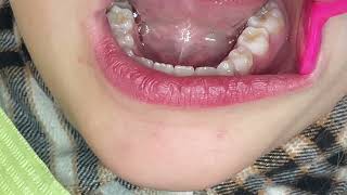 How do I instrument a deciduous tooth? by Hygiene Edge 2,266 views 4 months ago 1 minute