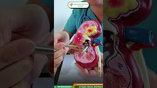AV Fistula for Dialysis | Safe &amp; Long-Term Access Option | Jharkhand Charitable Hospital