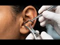 You Won’t Believe How This Tiny Thing Ended Up Inside Her Ear…